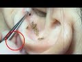 Черные точки в ухе - как избавиться от прыщей в ухе ОСОБАЯ ТЕХНИКА | Removal Blackheads on The Ear