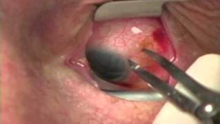 Intraocular Injection of Ranibizumab Therapy for Neovascular Age-Related Macular Degeneration
