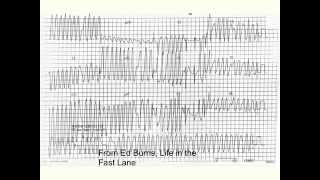 Wolff Parkinson White syndrome (WPW)
