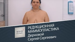 Редукционная маммопластика  / Дерновой Сергей Сергеевич