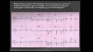 მარცხენა პარკუჭის წინა-გვერდითი კედლის მწვავე ინფარქტი Q კბილების გარეშე / ეკგ დიაგნოსტიკა