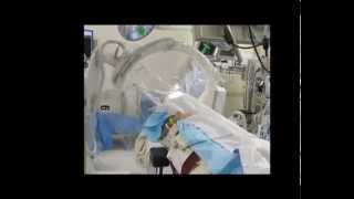 Awake Brain Surgery: Deep Brain Stimulator (DBS) Implantation for Parkinson's Disease.