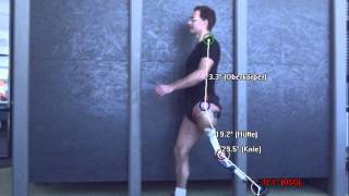 Amputee gait analysis with above knee prosthetic leg