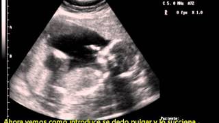Ecografia de un bebe de 19 semanas de gestacion que se chupa el dedo