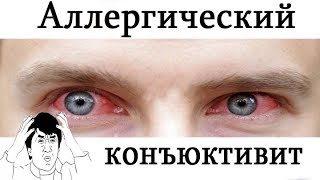 [ Dr. Ozz ] Аллергический конъюнктивит. Все что нужно знать. [ Помощь больному ]
