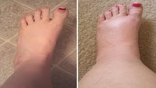 Was verursacht Wasserretention und wie man es vermeidet