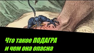 ЧТО ТАКОЕ ПОДАГРА И ЧЕМ ОНА ОПАСНА