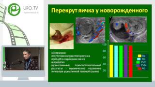 Юткина М С - Перекрут яйчка у детей, возможности ультразвуковой диагностики