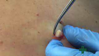 Removal of an Epidermal Cyst along the midback