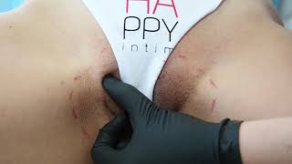 Увеличение больших половых губ и интимное отбеливание - Labia Majora Augmentation & Vulva Bleaching