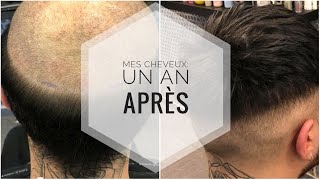 MES CHEVEUX DE A à Z! (Prothèse capillaire, greffe de cheveux, calvitie, lace wig, implants)