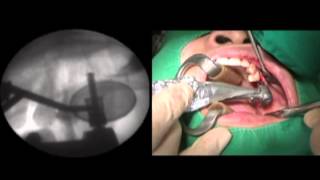 OSUNG Sinus Water Lift System - Crestal Approach - Video #1