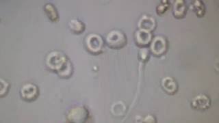КРОВЬ И СПЕРМАТОЗОИДЫ в МОЧЕ под микроскопом!!! BLOOD And SPERMATOZOA in URINE under a microscope!!!