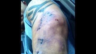 BOSTIN LOYD INJECTION CONSEQUENCES !!!!