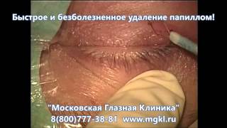Удаление папиллом  на верхнем и нижнем веке глаза - операция