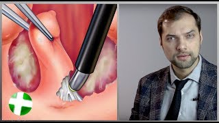 Коблация - удаление миндалин (гланд) без боли. Медликбез Отоларингология.