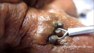 Gold Mine Of Black Heads On Nose