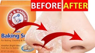 How to Instantly Remove Blackheads With Baking Soda