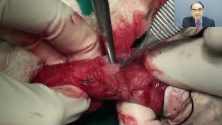 Penectomy for Carcinoma Penis - step by step - Prof. Chintamani
