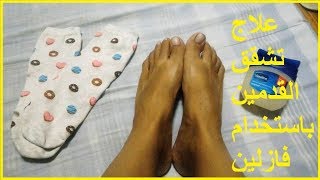 علاج تشقق القدمين باستخدام فازلين