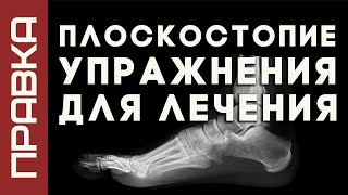 Упраженения для лечения плоскостопия | метод Правка Атланта