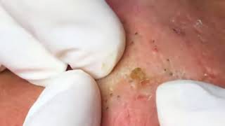 Beauty Video: Removing whitehead and blackhead on poor face
