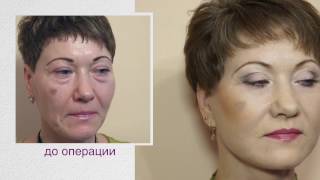 Подтяжка лица - невероятный результат! Пластическая операция до и после.