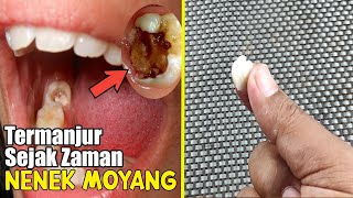 DALAM HITUNGAN MENIT, SAKIT GIGI BENGKAK MAUPUN BERLUBANG SEMBUH PERMANEN