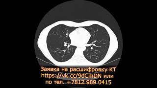 Эмфизема легких на КТ расшифровке органов грудной клетки