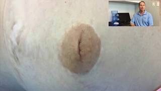 Top Plastic Surgeon Dr. Michael Fallucco corrects an inverted nipple (Surgery)