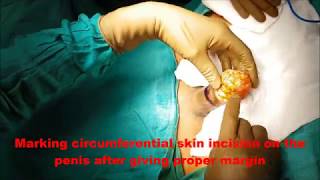 Partial Penectomy for penile cancer (Amputation of penis)
