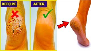 How to Get Rid of Cracked Heels   3 Simple Home Remedies for Cracked Heels !!