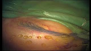 frontoorbital mucocele eyebrow incision by Prof Dr Selçuk YILMAZLAR