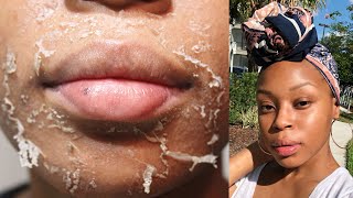 CHEMICAL PEEL EXPERIENCE | The Process, Peeling, + Before & After | No More Acne & Dark Marks!