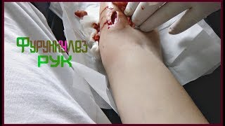 VLOG"Фурункулез обеих рук"