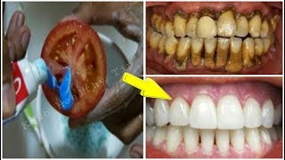 Magical Teeth Whitening Remedy | Get whiten Teeth at home in 1 minutes | Koko Healthy Tip