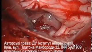 Опухоли спинного мозга. Удаление опухолей спинного мозга.