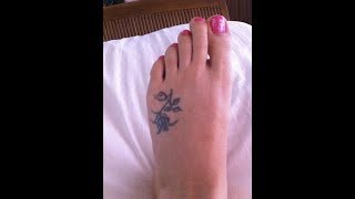 Gore Warning DO NOT OPEN traumatic foot amputation skin grafts below knee amputation