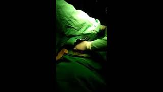 Abortion hydrocele