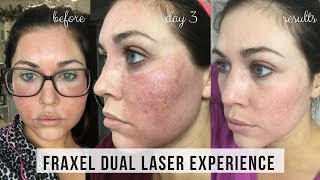 FRAXEL DUAL LASER TREATMENT FOR ACNE SCARS | DAY BY DAY RESULTS | KAILYN CASH
