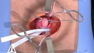 Inguinal Hernia Surgery 3D Medical Animation - Open Procedure