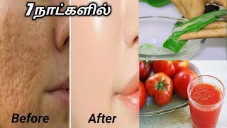 முகத்தில் உள்ள சிறு சிறு குழிகள் (open pores)  மறைய.....