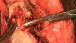 EMASCULATION -TOTAL PENECTOMY WITH PERINEAL URETHROSTOMY FOR CA PENIS BY DR.MARIMUTHU SARAVANAMUTHU
