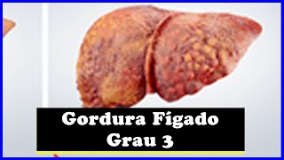 Gordura no Fígado Grau 3