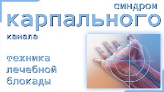 блокада при синдроме запястного канала