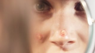 Pubertet (7:8): Kviser og svette // Puberty: Zits and sweat