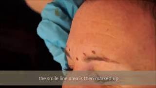 Muscle Relaxing Injections With Nurse Catherine at Dermacare Salon