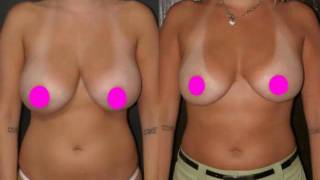 Breast Reduction by Liposuction Technique: Chicago Plastic Surgeon, Dr. Otto Placik