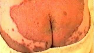 Psoriasis РЕАЛЬНОЕ ЛЕЧЕНИЕ ПСОРИАЗА БАЛЬЗАМ+7 flv
