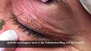 ACCOR Plasma Pen - Lidlifting ohne OP
